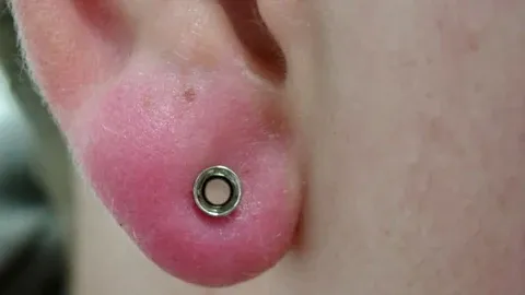 Vùng lỗ tai bị sưng đỏ và tiết dịch mủ sau khi bấm